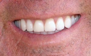 Close-up of a man’s teeth while smiling after receiving dental treatment with the waterlase dental laser at Akron Smile.